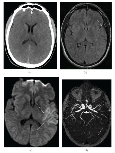 Hemiparesis : Causes, symptoms, test and treatment | brain MRI