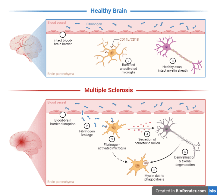 Multiple sclerosis : difference between normal brain and ms brain