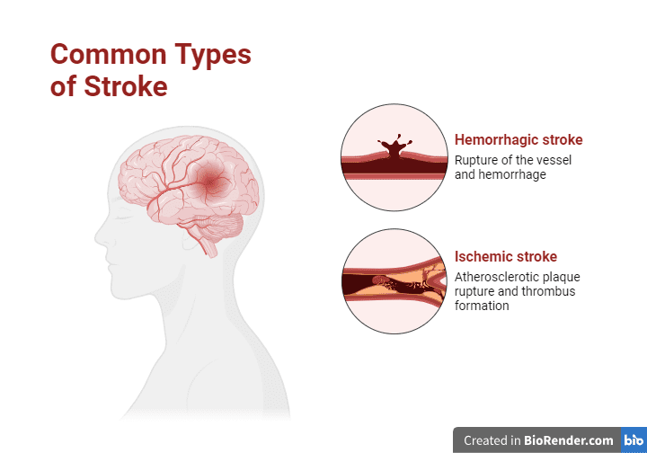 stroke : understanding causes and management